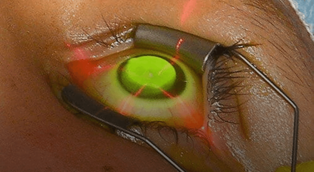 Crosslinking Corneal Acelerado