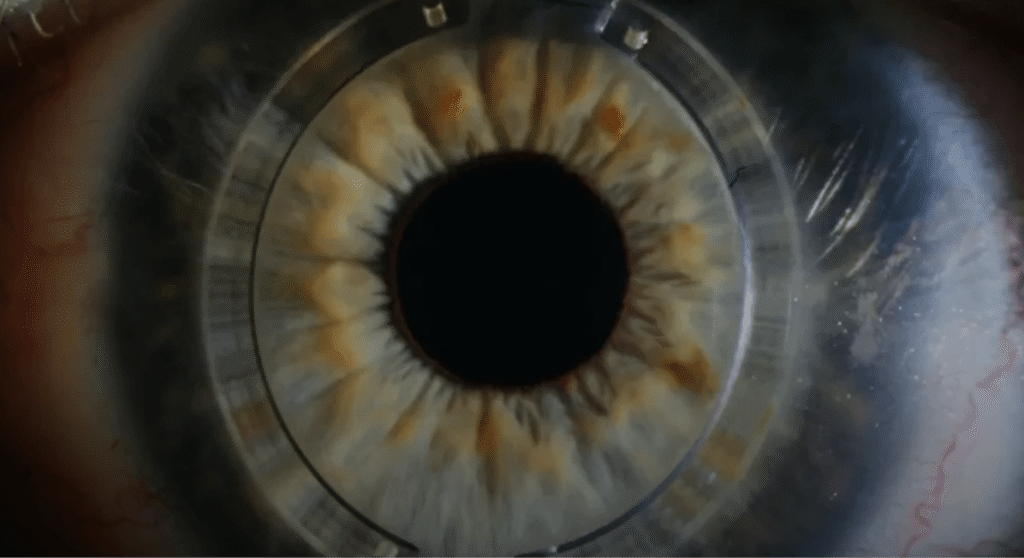 Tratamiento de Queratocono con Anillos Corneales